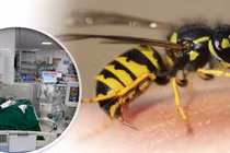 Bé gái 9 tuổi ở Nghệ An nguy kịch vì ong vò vẽ đốt dày đặc