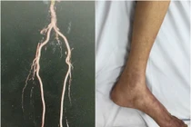 Phẫu thuật bắc cầu mạch chi cứu đôi chân cụ ông 84 tuổi