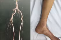 Phẫu thuật bắc cầu mạch chi cứu đôi chân cụ ông 84 tuổi