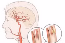 Cứu bệnh nhân đột quỵ não cấp do tắc động mạch cảnh