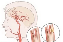 Cứu bệnh nhân đột quỵ não cấp do tắc động mạch cảnh
