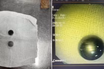 2 ngày cấp cứu 4 trường hợp nuốt dị vật, tổn thương nặng đường tiêu hóa