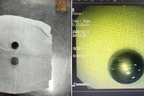 2 ngày cấp cứu 4 trường hợp nuốt dị vật, tổn thương nặng đường tiêu hóa