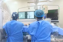 Stent chuyển dòng cứu người bệnh 50 tuổi bị phình lớn mạch máu não