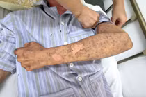 Bỏng rát toàn thân, mù tạm thời vì silicon chống dột