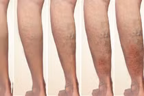 Suy tĩnh mạch chi dưới, hiểu đúng để phòng ngừa, điều trị hiệu quả