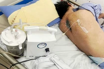 Thoát liệt nhờ phát hiện nhiễm nấm tại vết mổ cột sống ngực