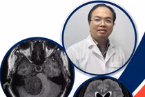 Nhìn mờ, méo miệng, thai phụ sinh con lần 5 phát hiện u não lớn