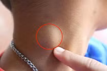 Nổi hạch không chỉ viêm nhiễm mà có thể lao, ung thư