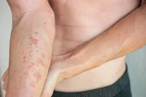 Ngứa da kéo dài có phải do gan yếu?