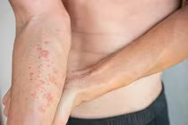 Ngứa da kéo dài có phải do gan yếu?