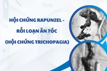 Bé trai 7 tuổi phải phẫu thuật tắc ruột vì thích ăn tóc