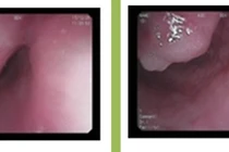 Nội soi tiêu hóa vì nuốt nghẹn, phát hiện khối u thực quản kích thước lớn