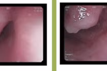 Nội soi tiêu hóa vì nuốt nghẹn, phát hiện khối u thực quản kích thước lớn