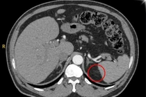 Phát hiện khối u thượng thận sau 15 năm tăng huyết áp không rõ nguyên nhân
