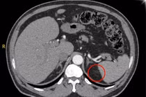 Phát hiện khối u thượng thận sau 15 năm tăng huyết áp không rõ nguyên nhân