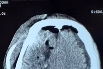 Ngã sau cơn động kinh, người đàn ông 55 tuổi xuất huyết não trán, thái dương