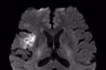 Đi thăm núi Bà Đen, cụ ông 74 tuổi đột quỵ được cứu sống ngoạn mục