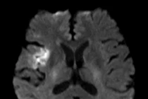 Đi thăm núi Bà Đen, cụ ông 74 tuổi đột quỵ được cứu sống ngoạn mục