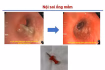 Xem điện thoại ngậm đinh ghim, trẻ 13 tuổi nguy kịch