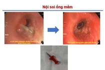 Xem điện thoại ngậm đinh ghim, trẻ 13 tuổi nguy kịch