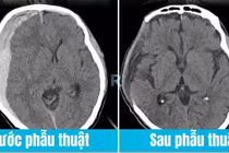Cứu sống bệnh nhân tụ máu não sau cú ngã nhẹ chỉ đau đầu gối