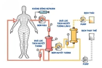 Lọc huyết tương thời điểm vàng loại bỏ yếu tố gây bệnh ra khỏi cơ thể