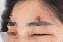 Nặn mụn trên trán, thiếu nữ 32 tuổi viêm mô tế bào nguy kịch