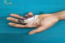 Tạo hình cứu bàn tay sẹo bỏng co kéo phức tạp hơn 25 năm