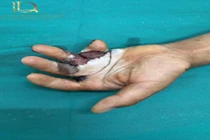 Tạo hình cứu bàn tay sẹo bỏng co kéo phức tạp hơn 25 năm