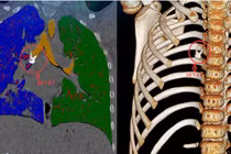 Ho kéo dài, trẻ 8 tuổi phát hiện răng trong phế quản