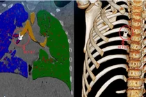 Ho kéo dài, trẻ 8 tuổi phát hiện răng trong phế quản