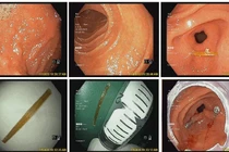 Bé 8 tuổi bị tăm tre xuyên thành dạ dày