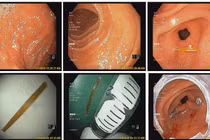 Bé 8 tuổi bị tăm tre xuyên thành dạ dày