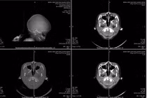 Báo động đỏ kịp thời cứu trẻ 6 tuổi chấn thương sọ não nặng