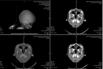 Báo động đỏ kịp thời cứu trẻ 6 tuổi chấn thương sọ não nặng