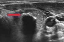 Vôi hóa nhân tuyến giáp có phải ung thư?