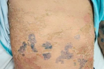 Da bong tróc do tắm lá chữa sởi