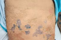 Da bong tróc do tắm lá chữa sởi