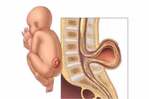 Cứu trẻ dị tật hiếm gặp, thoát vị màng não tủy, nứt đốt sống