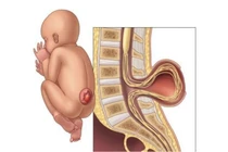 Cứu trẻ dị tật hiếm gặp, thoát vị màng não tủy, nứt đốt sống