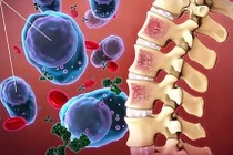 Nhận biết sớm bệnh xơ tủy ác tính nguy hiểm