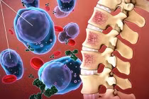 Nhận biết sớm bệnh xơ tủy ác tính nguy hiểm