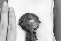 Nữ bệnh nhân 47 tuổi phải cắt tử cung vì thiếu máu do u xơ nhỏ