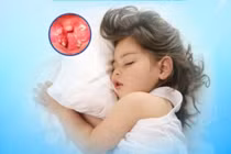 Ngưng thở khi ngủ do amidan quá phát ở trẻ nhỏ