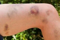 Nguy kịch vì dùng thuốc nam, cảnh báo bệnh hiếm cướp mạng trong vài ngày