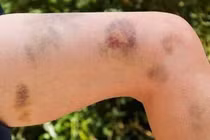 Nguy kịch vì dùng thuốc nam, cảnh báo bệnh hiếm cướp mạng trong vài ngày