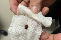 Bắt côn trùng di chuyển trong ống tai người phụ nữ ở Quảng Bình