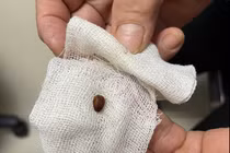 Bắt côn trùng di chuyển trong ống tai người phụ nữ ở Quảng Bình