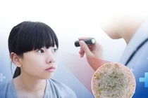 Trẻ 8 tuổi suy giảm thị lực nghiêm trọng vì giun đũa chó mèo trong mắt